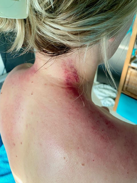 Nek en schouder na een cuppingbehandeling